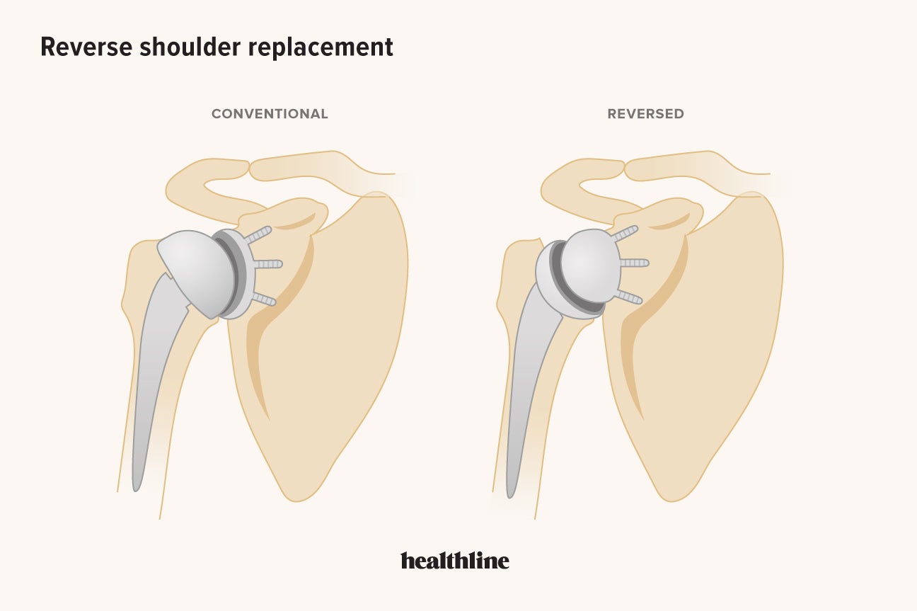 Your Guide To Reverse Shoulder Replacement And Recovery